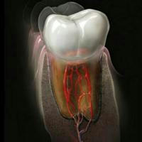 Endodontitis