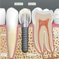 implant and implantology