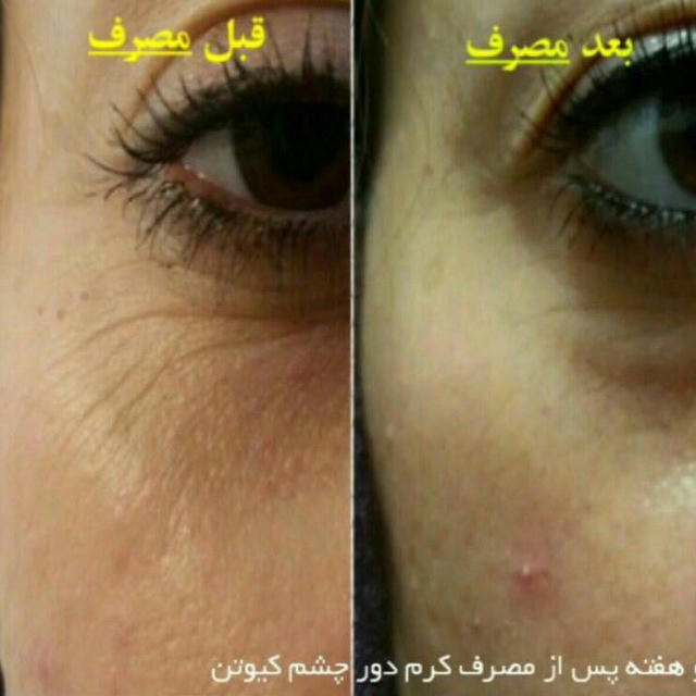 PMLM < before - after >