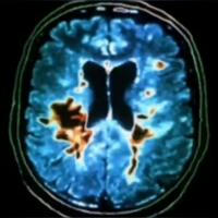 Рассеянный склероз | Неврология | Медицина | Multiple sclerosis | Neurology | Medicine