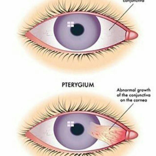 طب العيون Ophthalmology